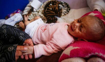 Gazzeli çocuklar açık nedeniyle yaşam mücadelesi veriyor