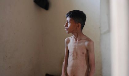Gazze'de çocukların açlık vakaları giderek artıyor